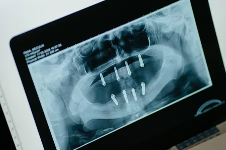 Radiografie panoramică cu implanturi, pe un monitor