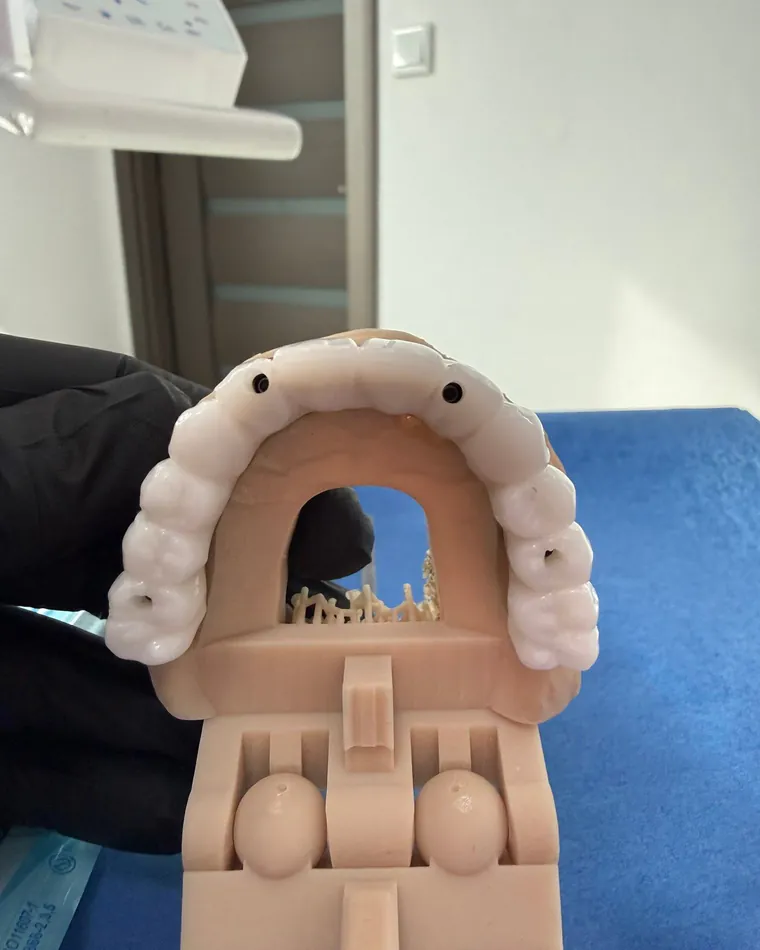 Lucrare dentară completă, înșurubată pe implanturi, montată pe modelul de lucru